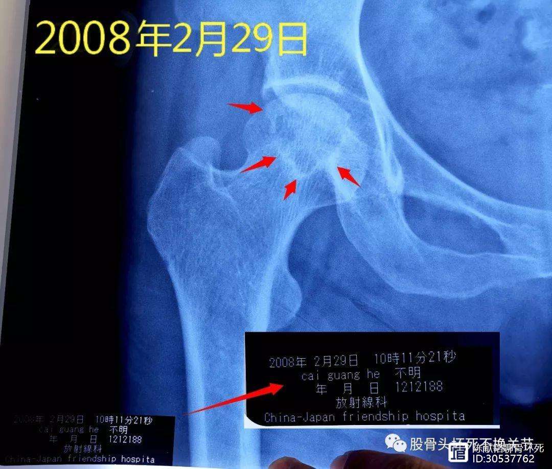 淄博人工骨头医保报销多少(人工骨头医保报销多少比例)